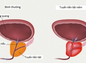 Tổng hợp các nguyên nhân dẫn đến viêm tuyến tiền liệt